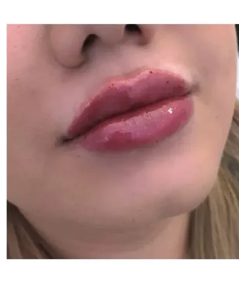 Lippen aufspritzen – Ergebnis 1 Lippen aufspritzen Ergebnis 1 – Patientin mit natürlich vollen Lippen