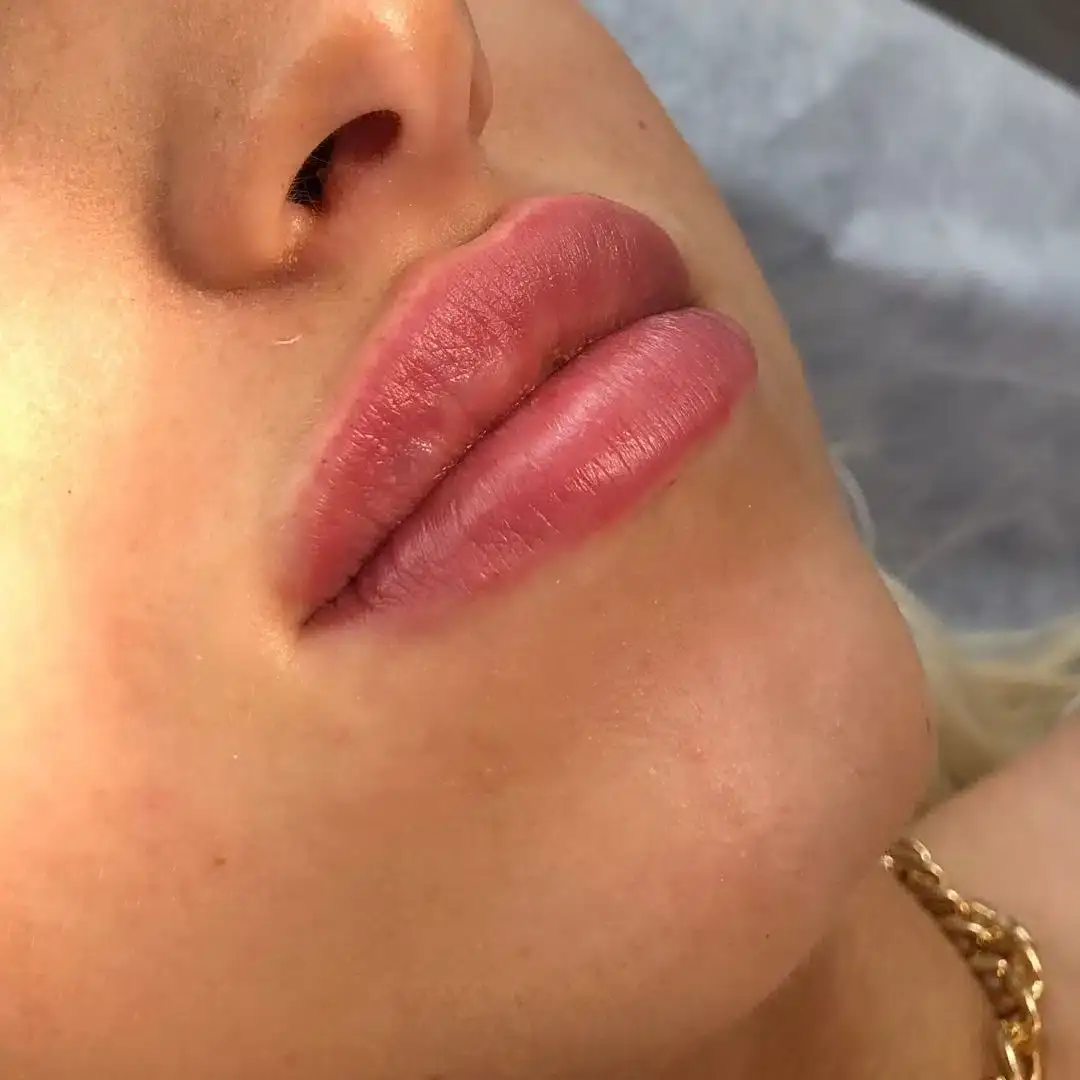 Lippen aufspritzen Ergebnis 1 – Patientin mit natürlich vollen Lippen