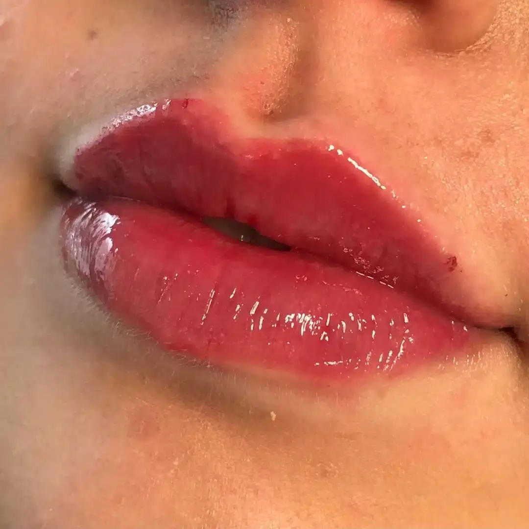 Lippen aufspritzen Ergebnis 2 – Patientin mit natürlich vollen Lippen