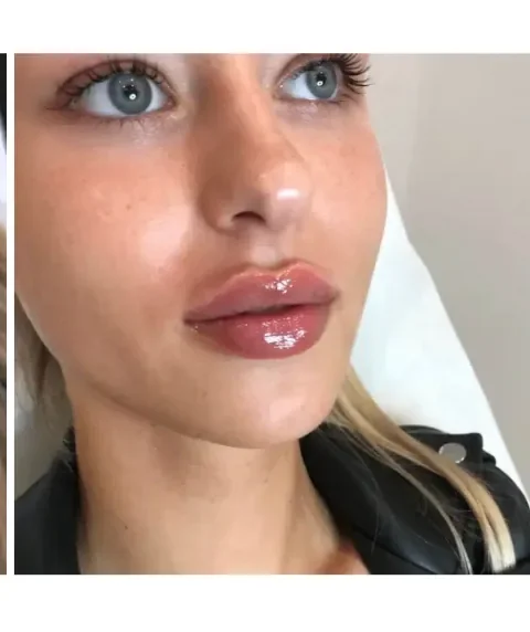 Lippen aufspritzen – Ergebnis 2 Lippen aufspritzen Ergebnis 2 – Patientin mit natürlich vollen Lippen