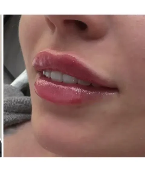 Lippen aufspritzen – Ergebnis 3 Lippen aufspritzen Ergebnis 3 – Patientin mit natürlich vollen Lippen