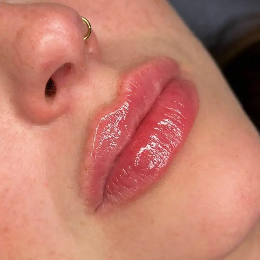 Lippen aufspritzen Ergebnis 4 – Patientin mit natürlich vollen Lippen