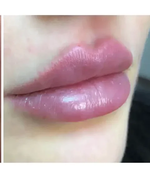 Lippen aufspritzen – Ergebnis 4 Lippen aufspritzen Ergebnis 4 – Patientin mit natürlich vollen Lippen