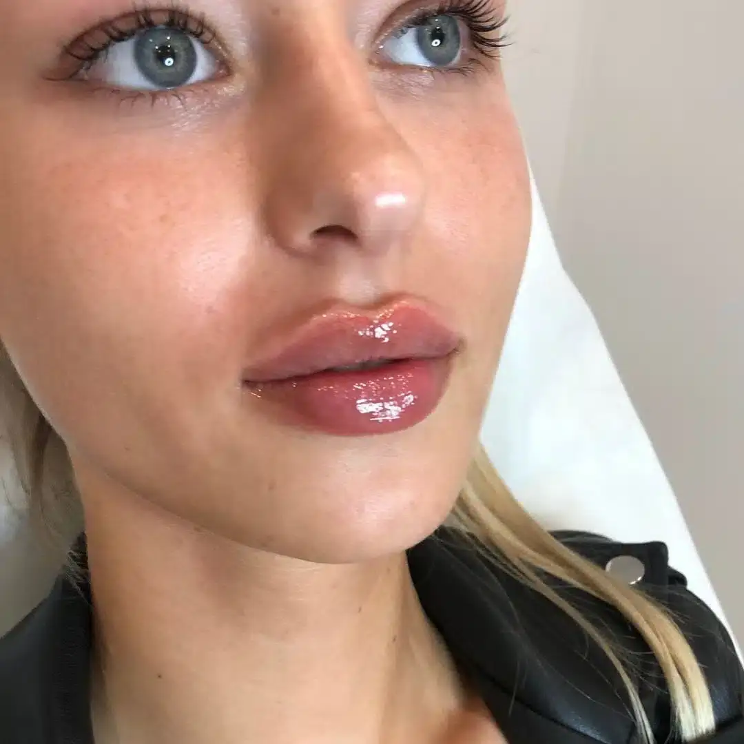 Lippen aufspritzen Ergebnis 5 – Patientin mit natürlich vollen Lippen