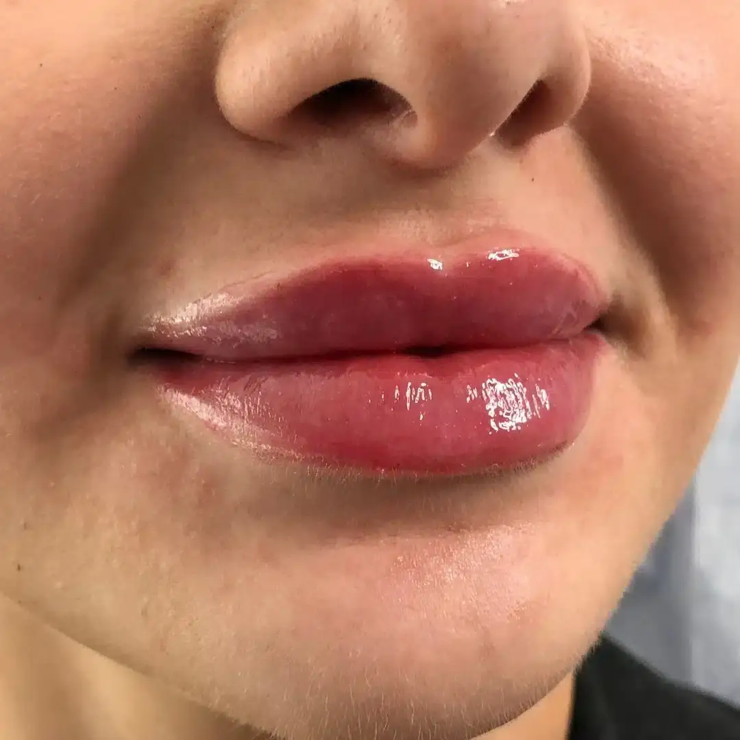 Lippen aufspritzen Ergebnis 7 – Patientin mit natürlich vollen Lippen
