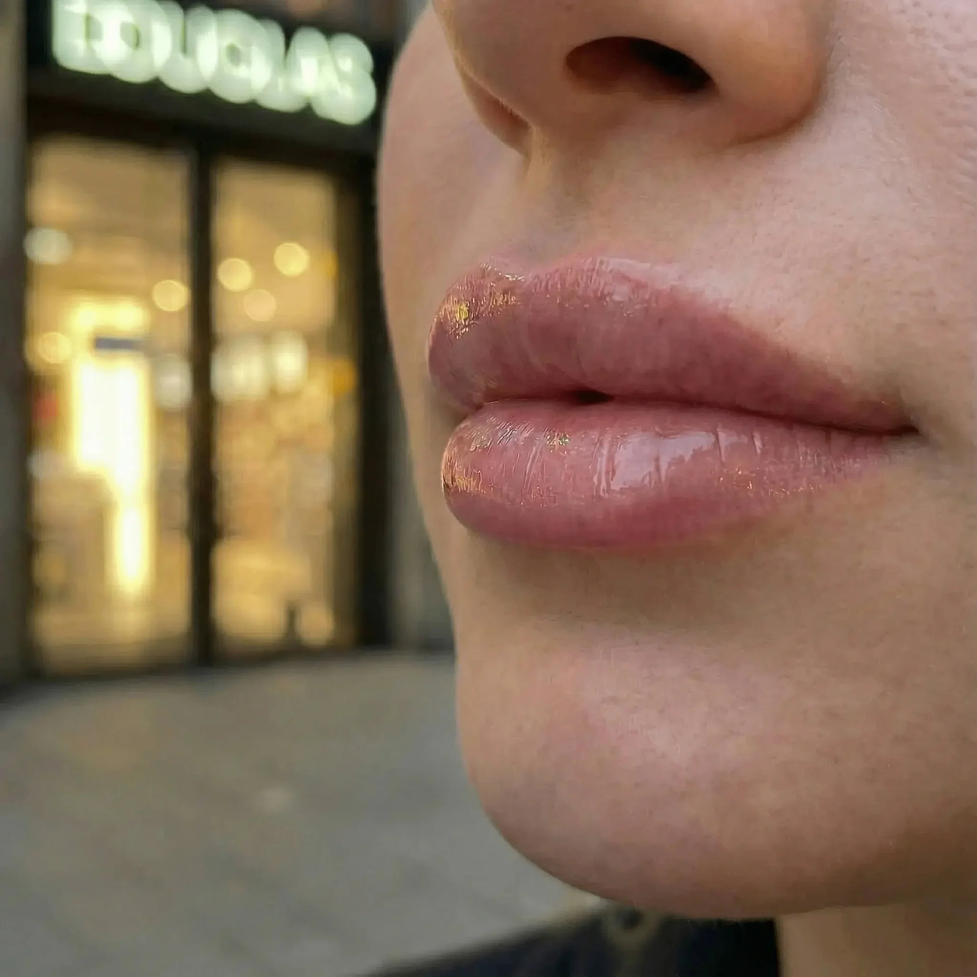 Lippen aufspritzen Ergebnis 8 – Patientin mit natürlich vollen Lippen